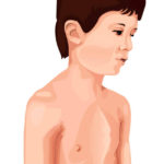 Increase Quality of Life with Pectus Carinatum Treatment