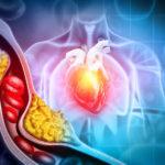 Start Lowering Your Cholesterol – Today